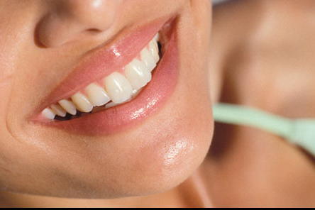 Teeth-whitening1